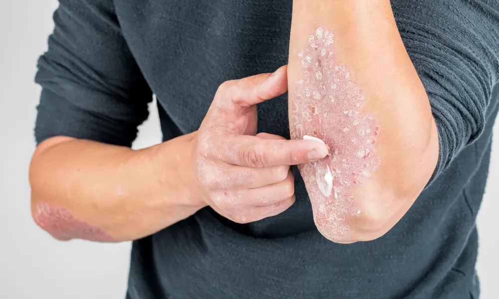 Past the Flakes: Crucial Things to Think About Before Treating Psoriasis