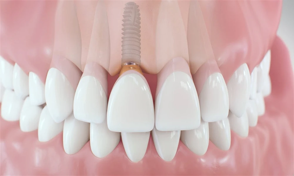 Are Dental Implants Covered by Insurance? Coverage Breaks Down Stage by Stage, and What to Confirm With Stubbs Dental